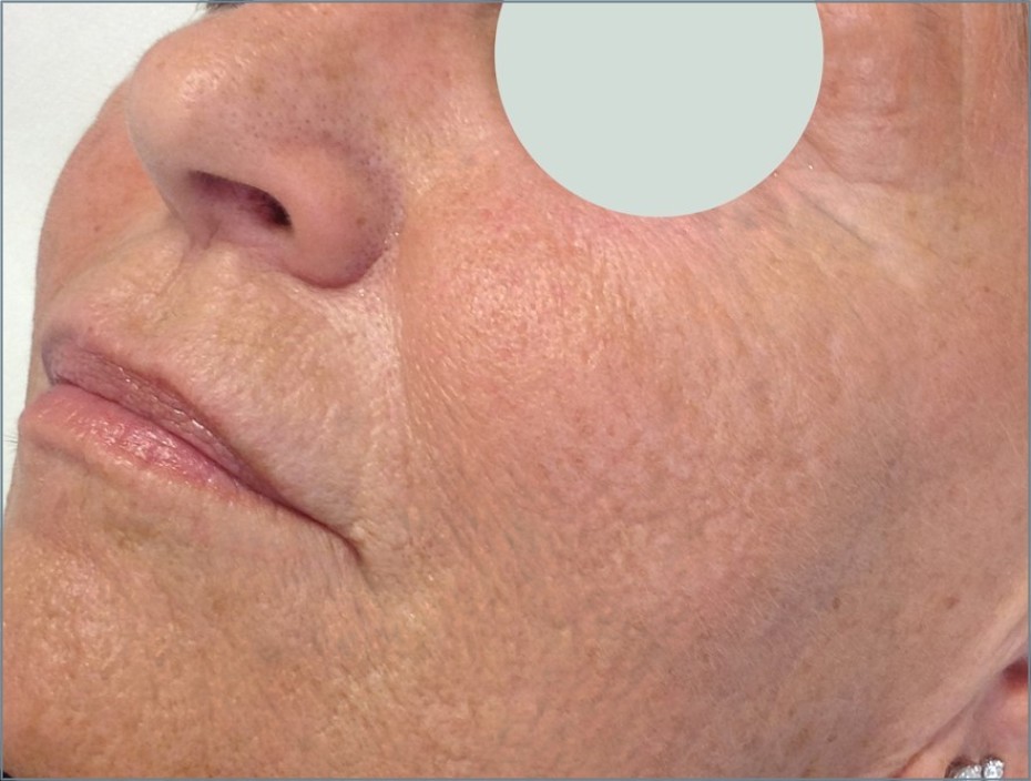 After fractional resurfacing treatment