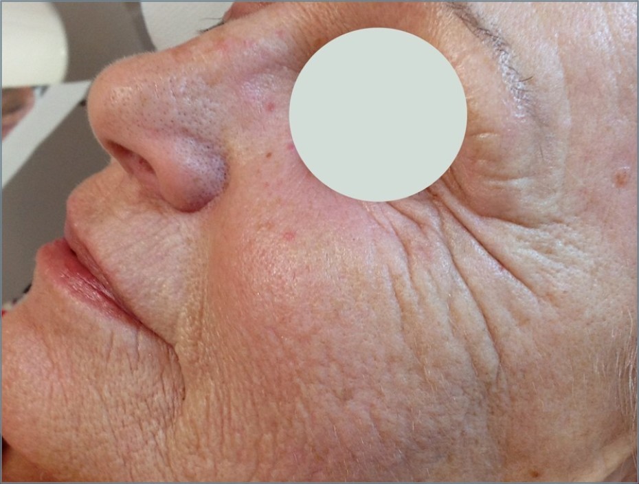Before fractional resurfacing treatment
