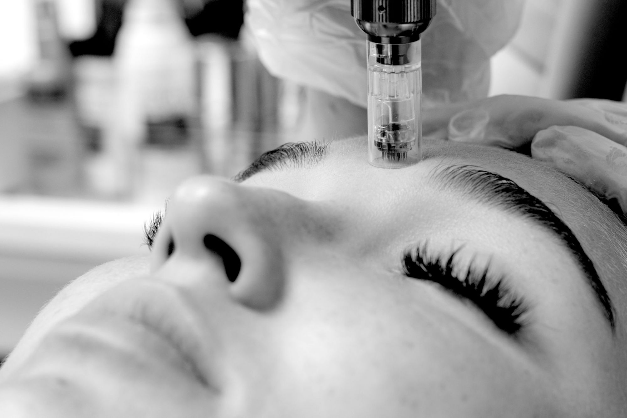 RF Microneedling treatment