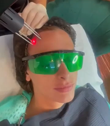 LightScan Fractional Laser skin resurfacing treatment