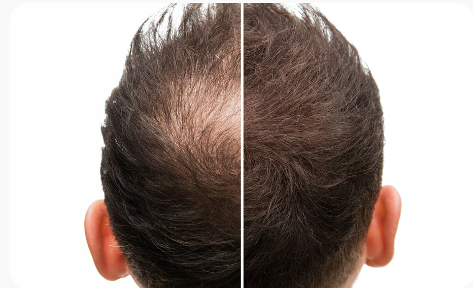 Before and after PRF hair restoration result