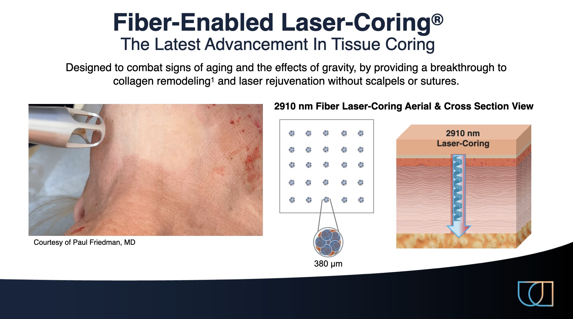 Manufacturer illustration showing Fiber-Enabled Laser-Coring treatment pattern and skin cross-section