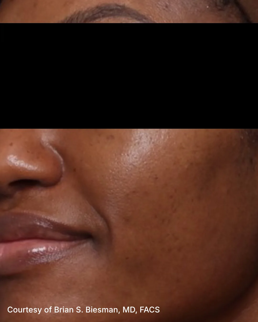 Before UltraClear 3DMIRACL treatment, patient example four