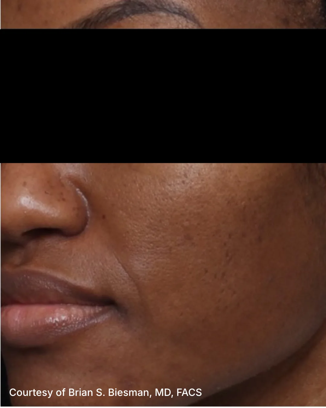 After UltraClear 3DMIRACL treatment, patient example four