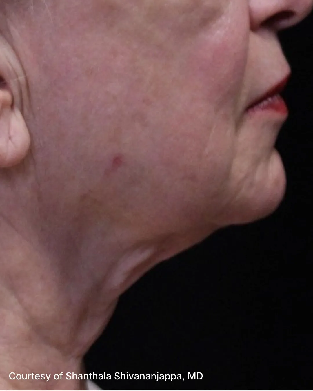 After one UltraClear Laser-Coring treatment for signs of gravity
