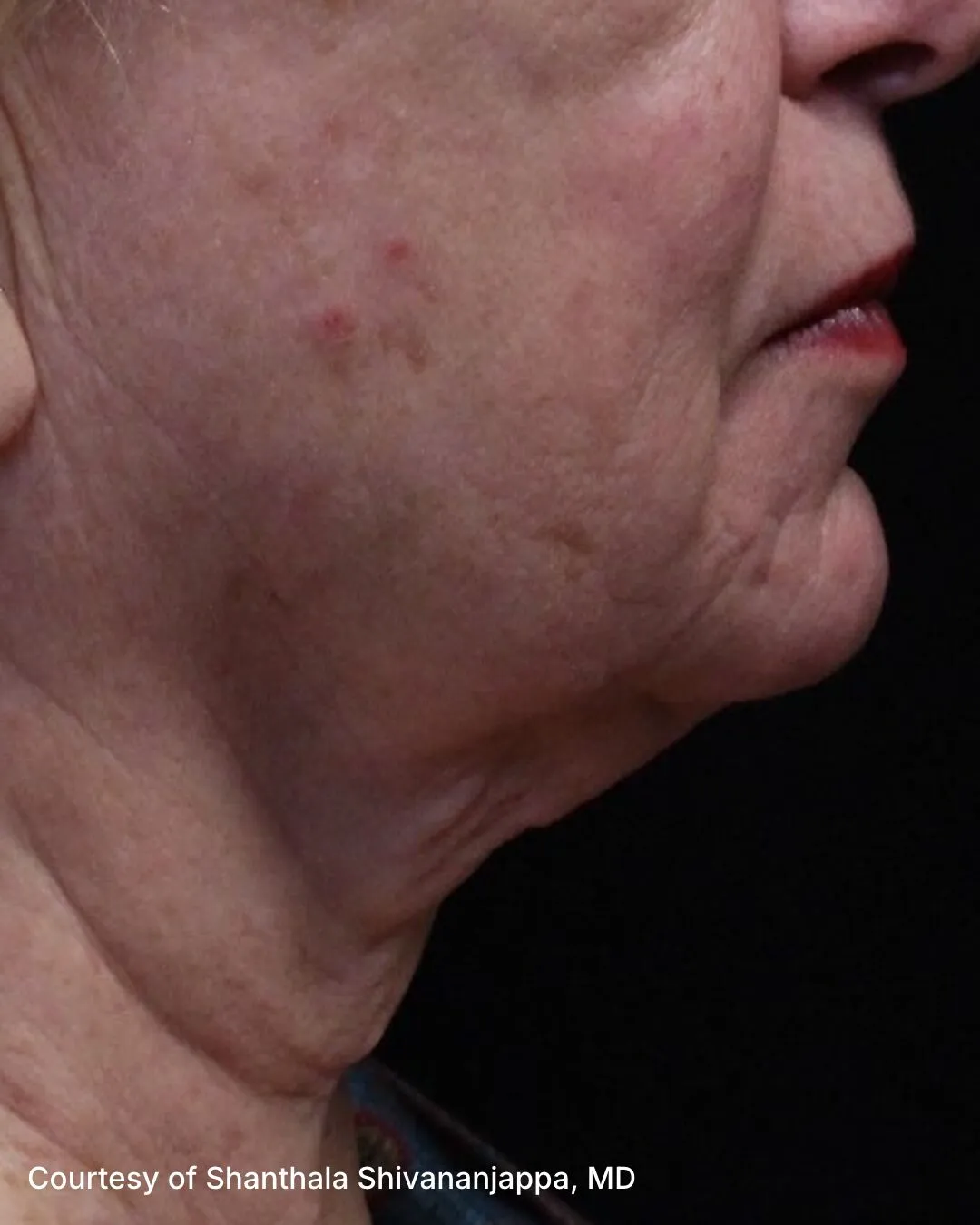 Before one UltraClear Laser-Coring treatment for signs of gravity