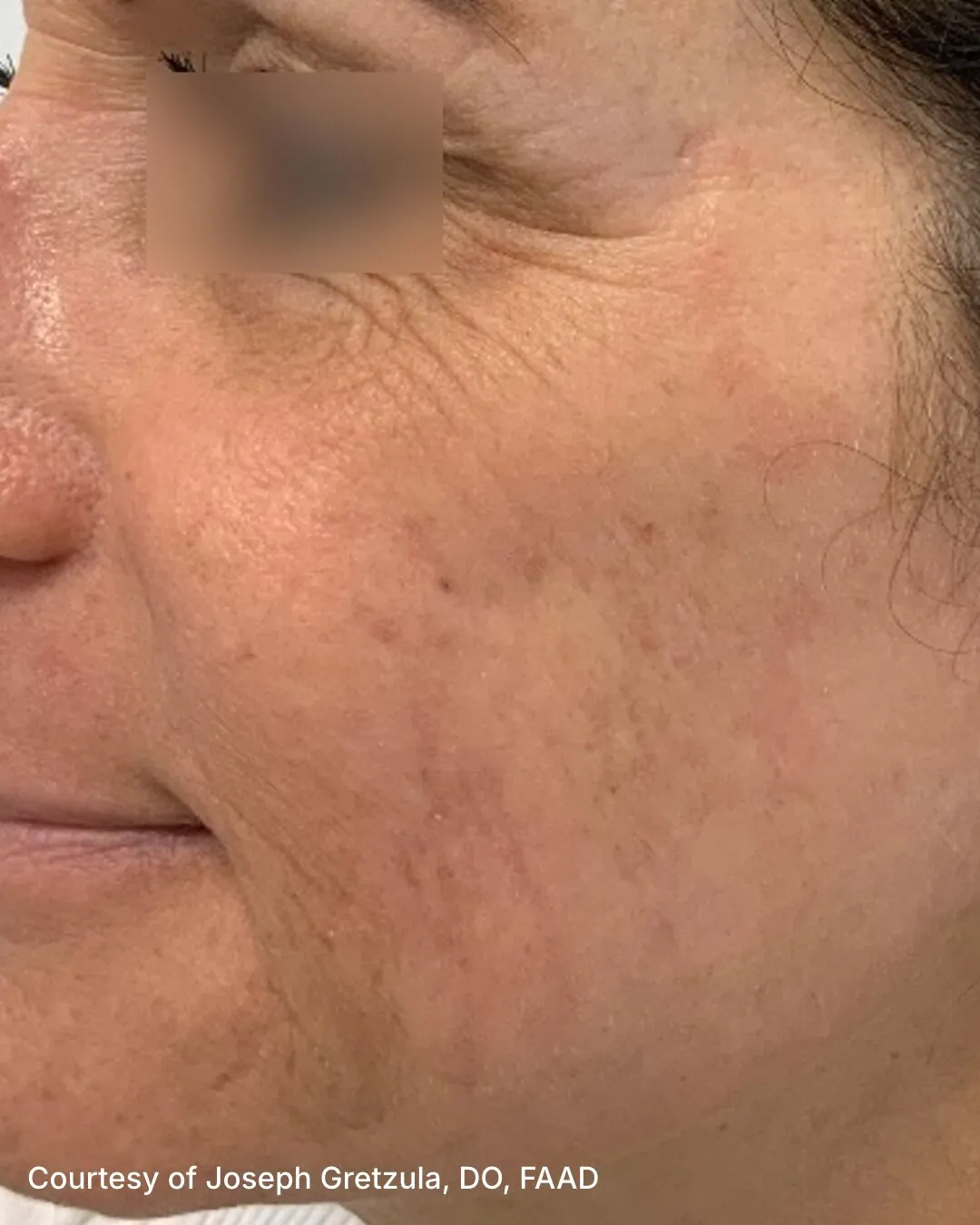 After one UltraClear Laser-Coring acne-scar treatment