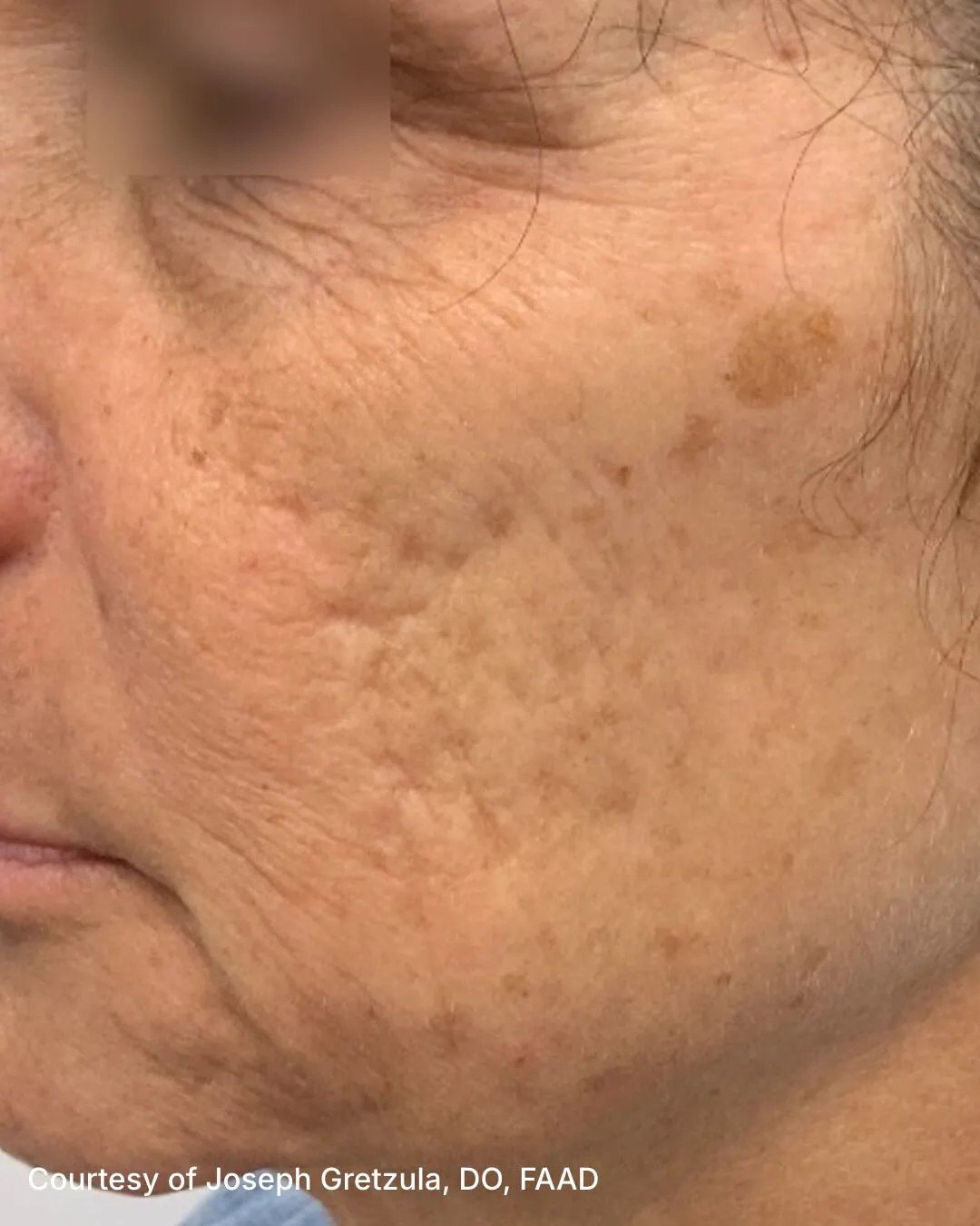 Before one UltraClear Laser-Coring acne-scar treatment