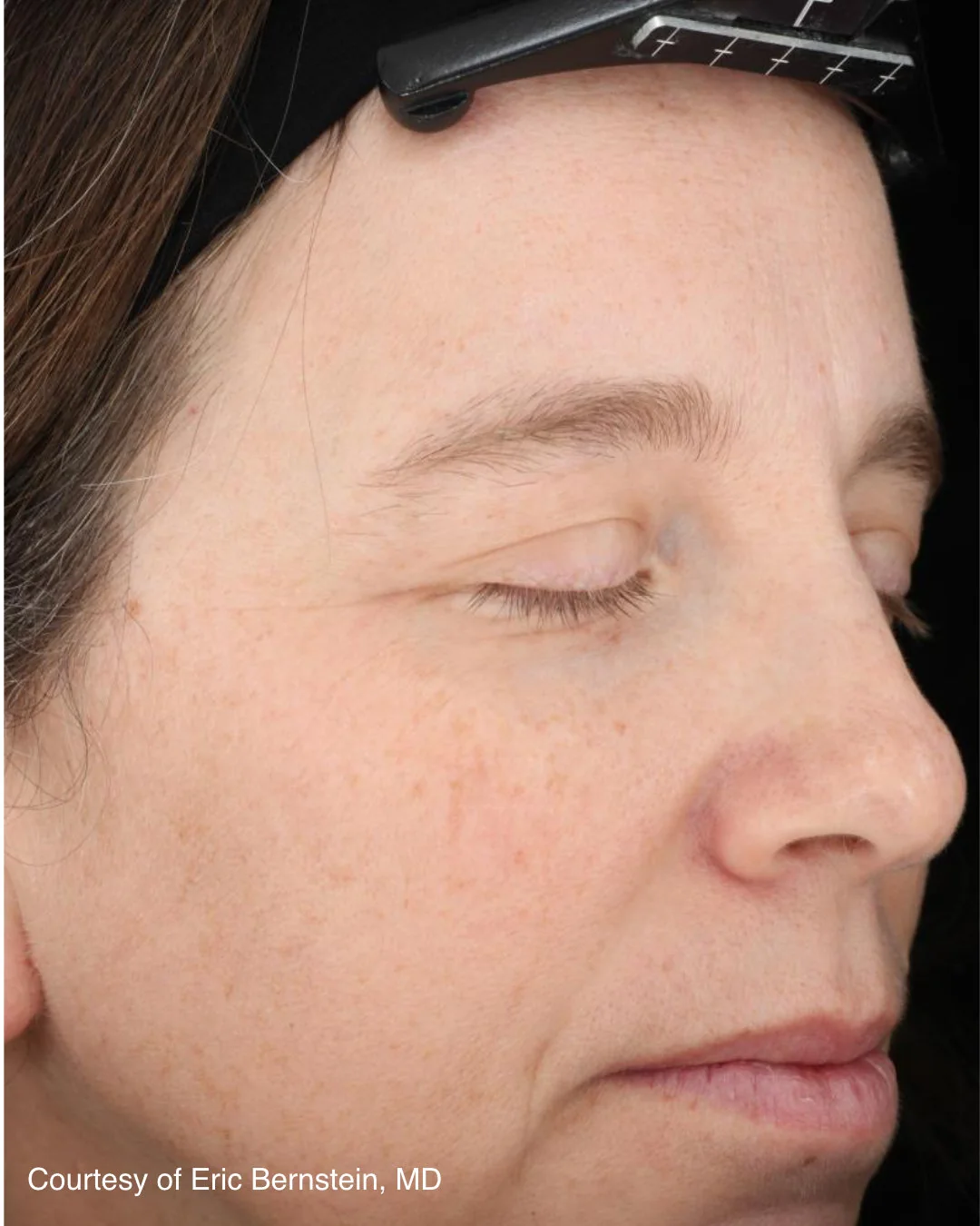 Before UltraClear 3DMIRACL treatment, patient example one