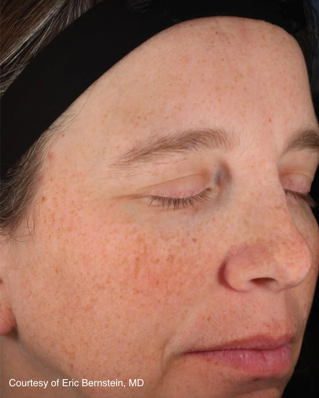 After UltraClear 3DMIRACL treatment, patient example one