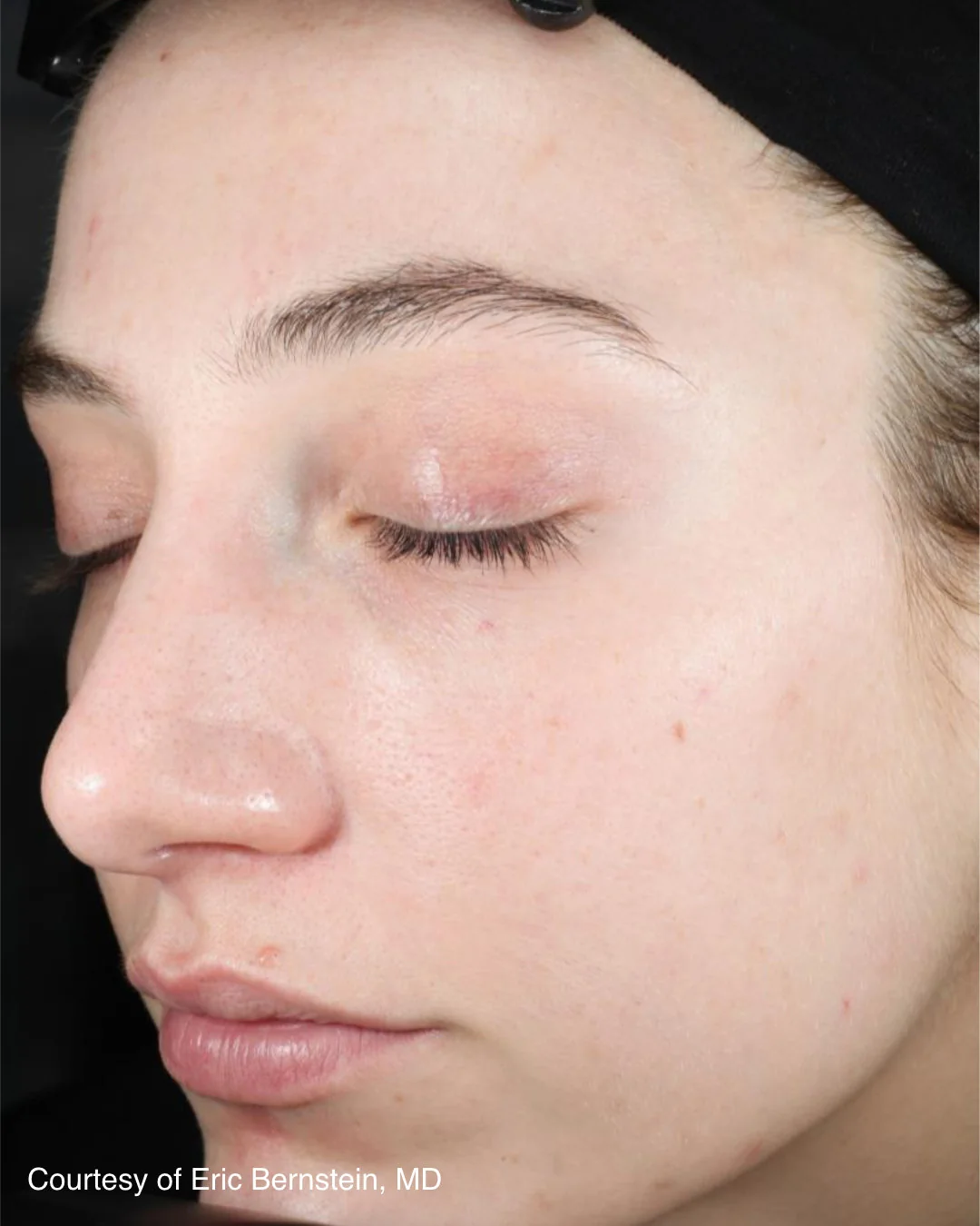 Before UltraClear 3DMIRACL treatment, patient example two