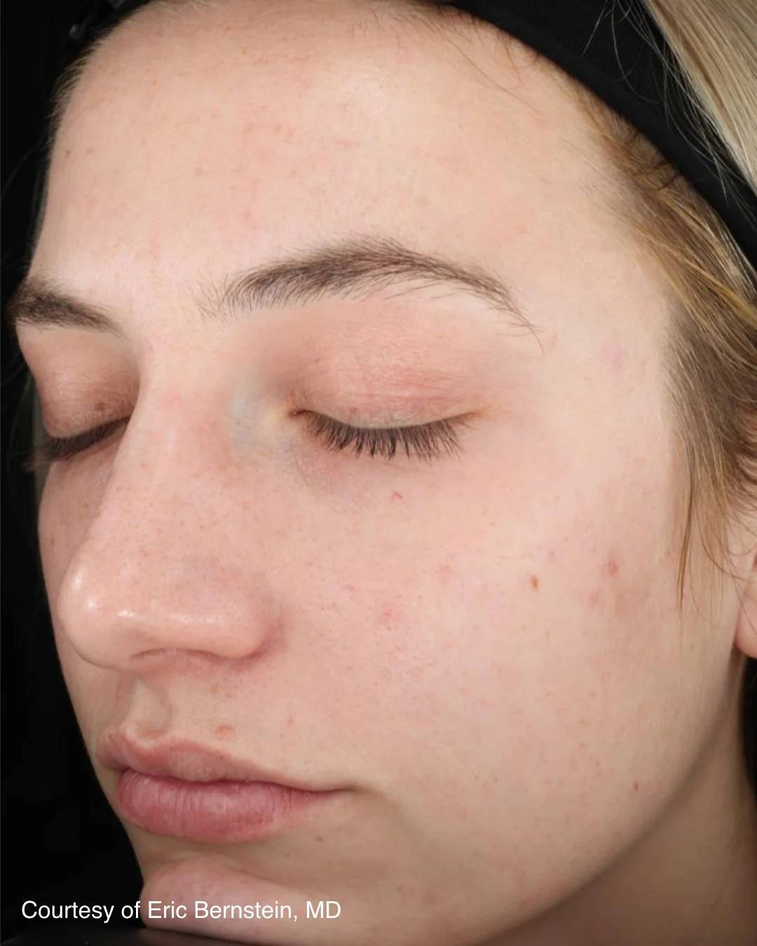 After UltraClear 3DMIRACL treatment, patient example two