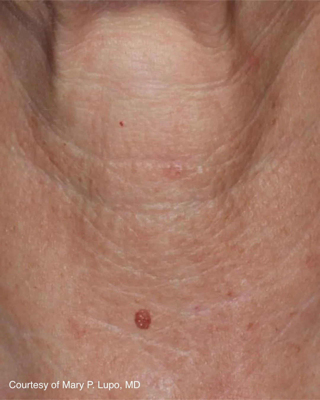 Before UltraClear 3DMIRACL treatment on the neck, patient example three