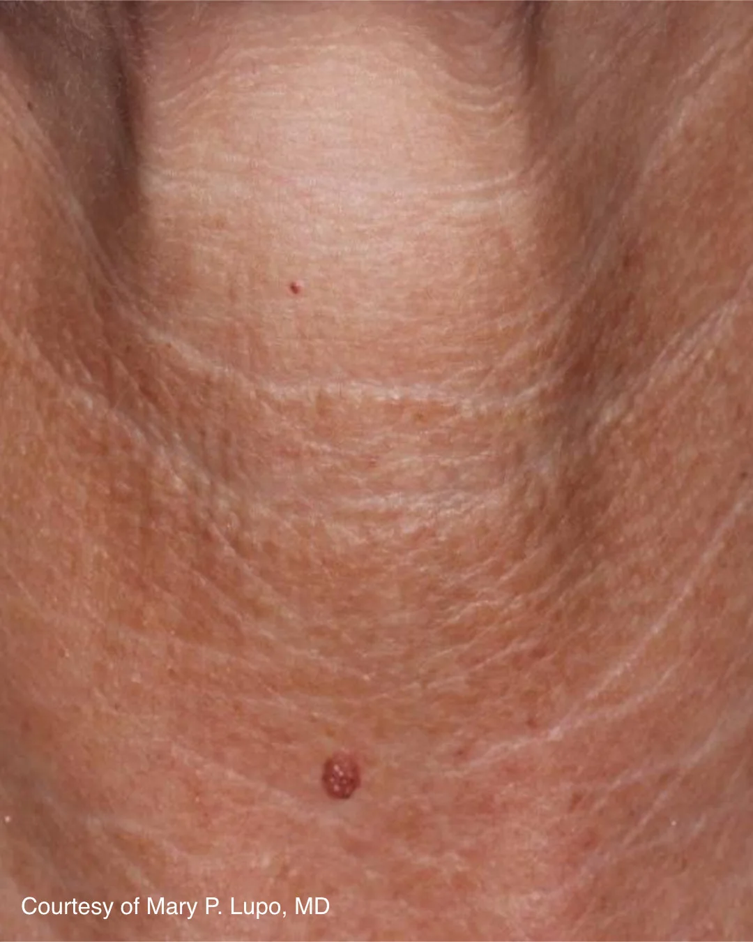 After UltraClear 3DMIRACL treatment on the neck, patient example three