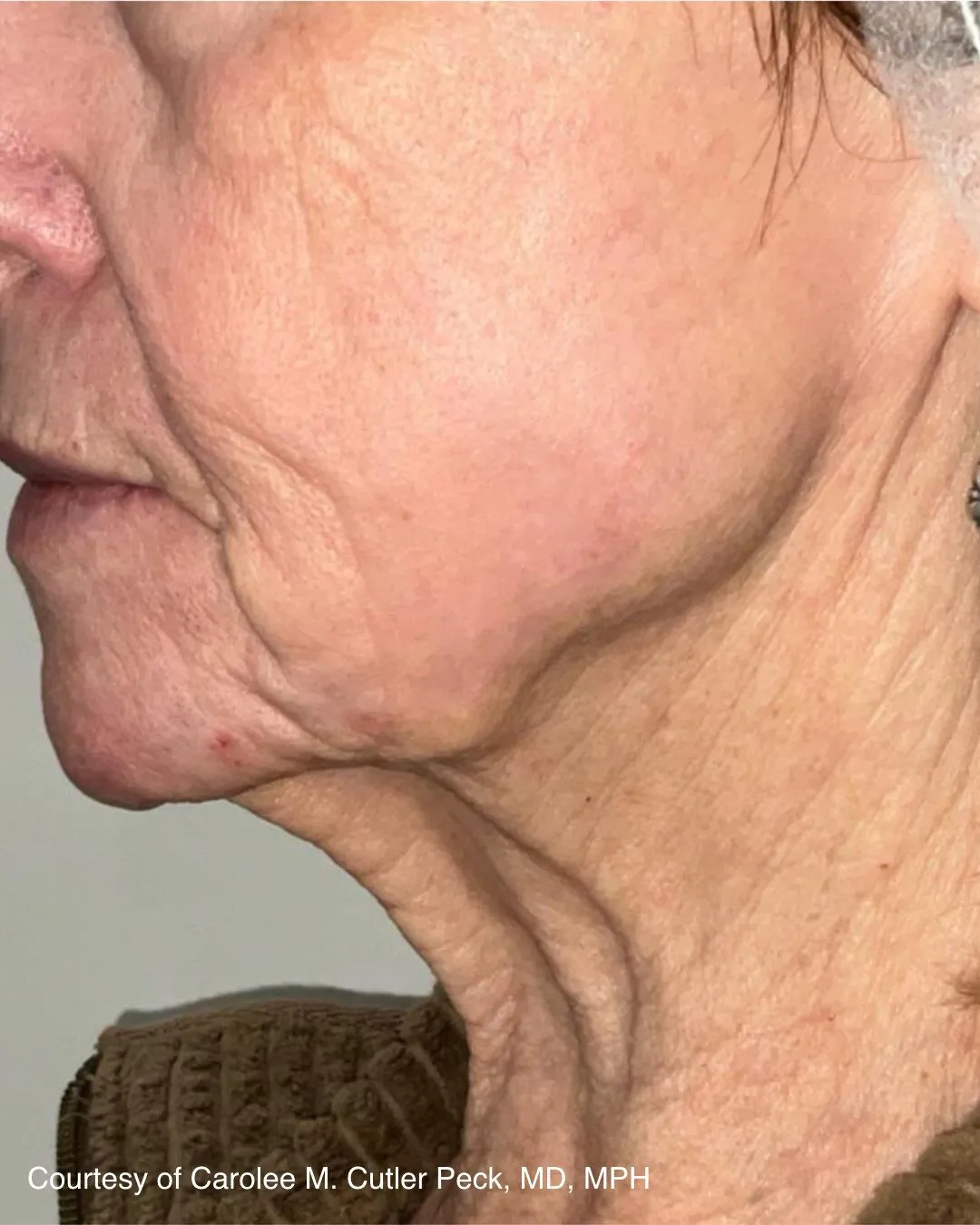 After one UltraClear Laser-Coring treatment for wrinkles