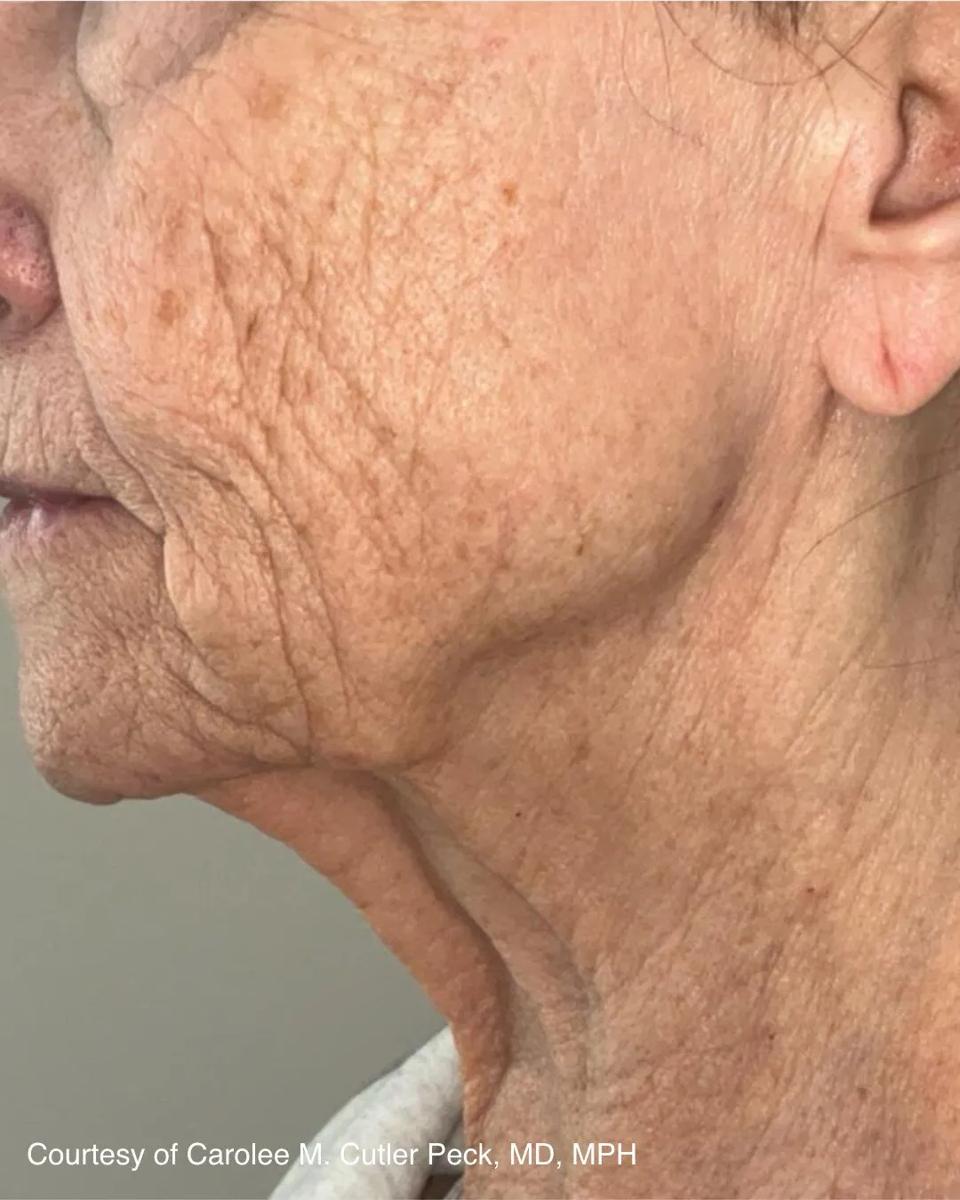 Before one UltraClear Laser-Coring treatment for wrinkles